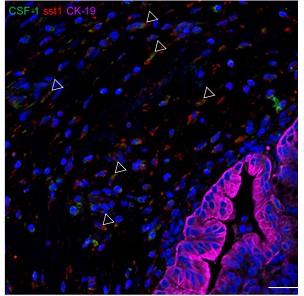 La normalisation des secrétions de protéines dans le microenvironnement tumoral bloque le développement de métastases dans le cancer du pancréas