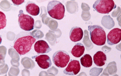 CD36 drives metastasis and relapse in acute myeloid leukemia
