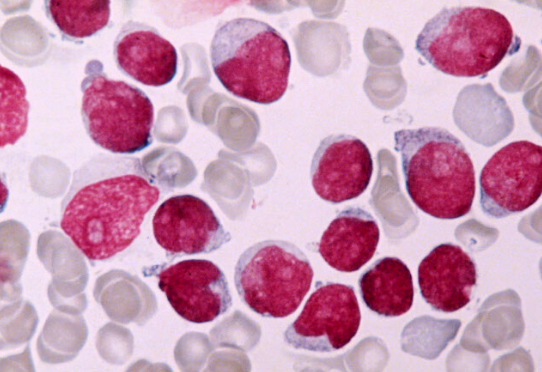 CD36 drives metastasis and relapse in acute myeloid leukemia