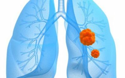 Lutter contre les cancers bronchiques