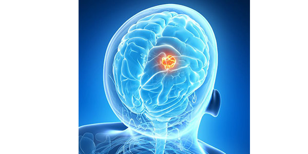 Résultats encourageant de la phase 1 de l’association de la Ré-irradiation stéréotaxique hypofractionnée en association avec le Durvalumab dans le Glioblastome en récidive .