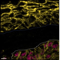 Etude de la contribution de lipides tumoraux dans l’évolution métastatique d’un mélanome cutané