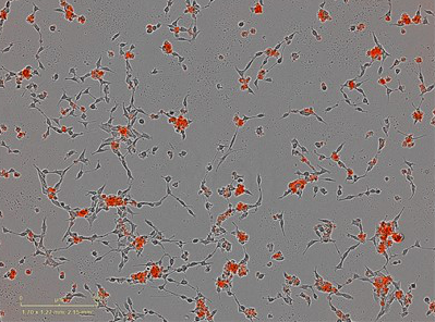 An oncolytic virus with strong appetence for the most aggressive type of pancreatic cancer cells